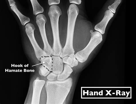 Hamate Fracture In Athletes Can Be Complex