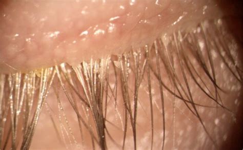 Demodex Eyelash Mites