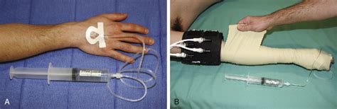 Peripheral Nerve Blocks | Anesthesia Key