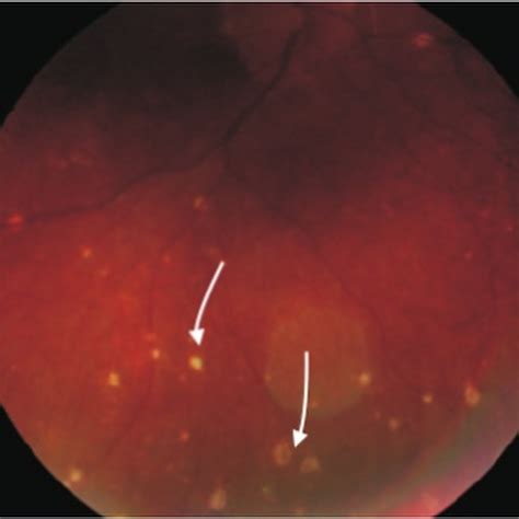 Ophthalmology Notes: Nodules in Ophthalmology