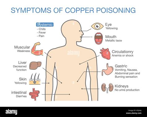 Chart of the Main Symptoms of Copper Poisoning Stock Vector Image & Art ...