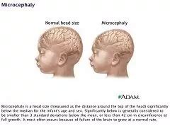 Microcephaly In Children - Treatment, Types, Causes, Symptoms | Diseases 2023