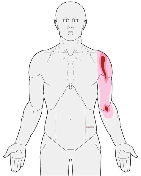 Shoulder | Integrative Works | Shoulder pain, Trigger points, Forearm pain
