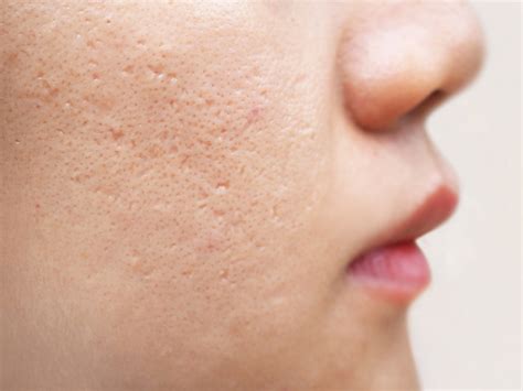 What causes pockmarks? Here’s what skincare experts say