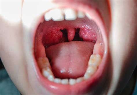 Healthy Tonsils Bilder – Durchsuchen 4,376 Archivfotos, Vektorgrafiken und Videos | Adobe Stock