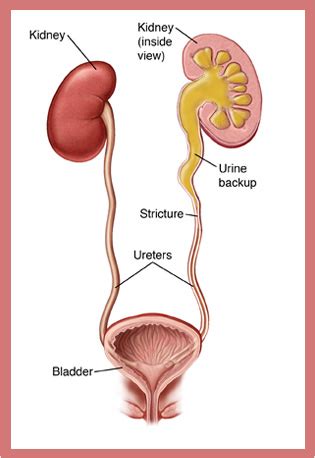 Treatment of Urethric Stricture Entails Best Urethral Stricture Surgery Recovery, Ureteral ...