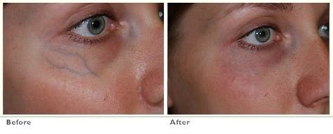 Sclerotherapy Under Eye Vein Removal - Blue Veins Under Eye