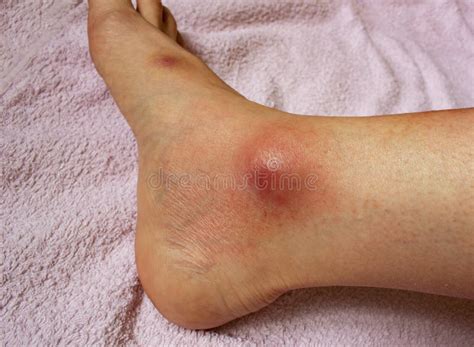 Bruised ankle stock image. Image of foot, bruise, emergency - 8647723