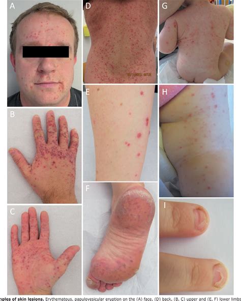 Figure 1 from Atypical Hand, Foot, and Mouth Disease Caused by Coxsackievirus A6 in Denmark: A ...