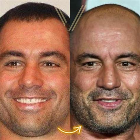 Joe Rogan Hair Transplant: Before and After Transformation