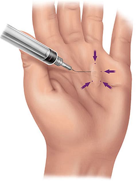 Dupuytren's Contracture - Causes, Symptoms, Treatment