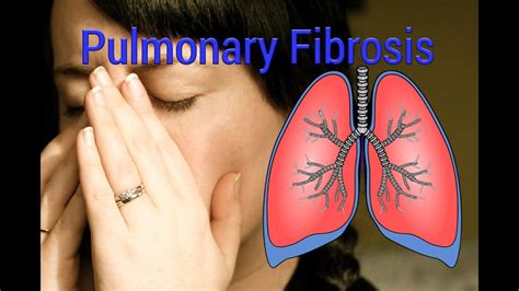 Pulmonary Fibrosis Clinical Presentation( English) - YouTube