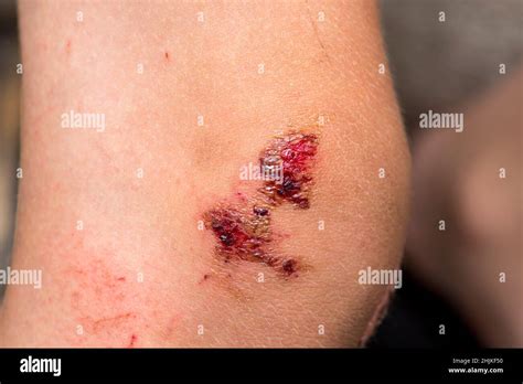 Skin scrape knee child hi-res stock photography and images - Alamy