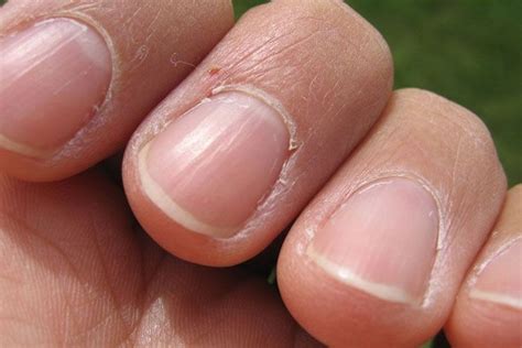 What Fingernails Tell About Your Health? 12 Possible Facts