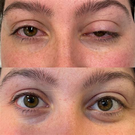 Don't Let Your Ptosis Hold You Back From Looking And Feeling Your Best