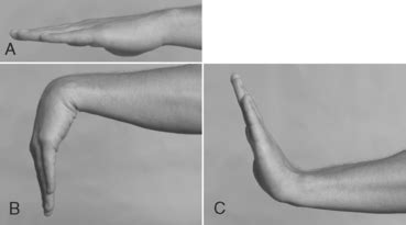 Dinner fork deformity : causes , symptoms & treatment