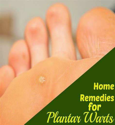 Leo Newton: How To Tell When Your Plantar Wart Is Gone