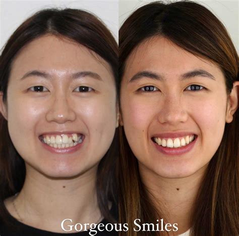 Celebs Transformed By Braces 10 Before And Afters 12t - vrogue.co
