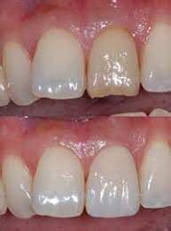 How to fix uneven teeth whitening - Cosmetic Surgery Tips