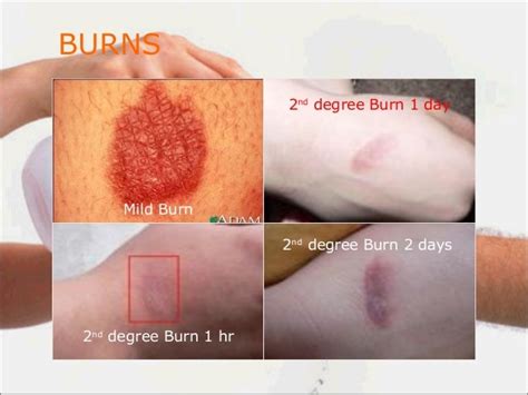 Pathophysiology, Nutritional Management of BURNS