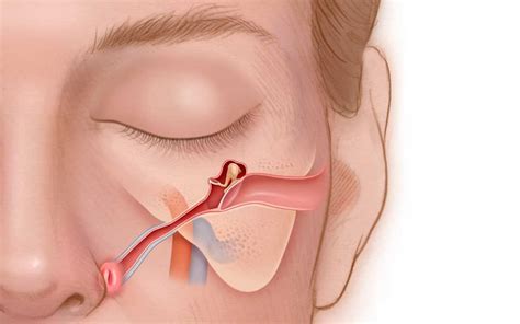 Eustachian tube dysfunction (ETD) and how to treat it