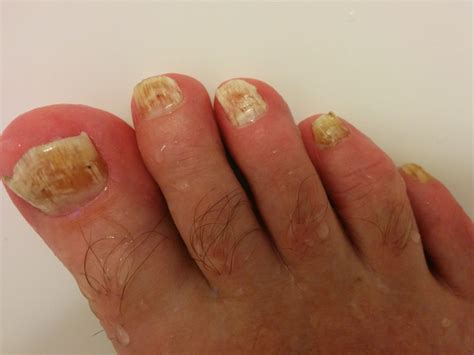 Fungus on both feet, left and right – Toenail Fungus