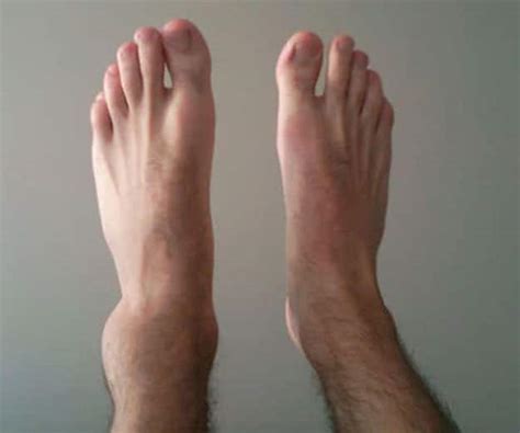 A Sprained Ankle - Causes, Symptoms, Types, Grades, Treatments