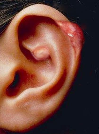 [Figure, Gout in the Ear Image courtesy S Bhimji MD] - StatPearls ...