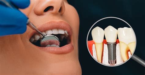 What You Need to Know About Titanium Dental Implants - Find Local Dentists