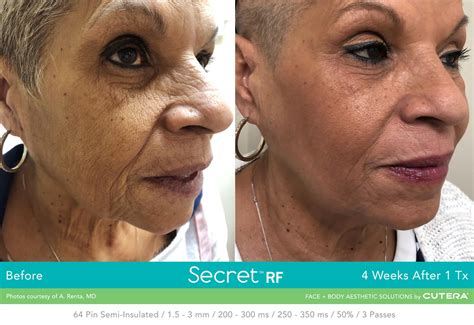 Secret RF Refine: RF+Micro-needling Full Face – South William Clinic & Spa