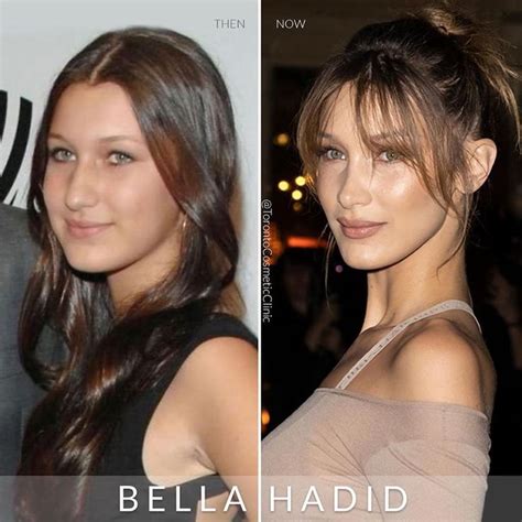 bella hadid before plastic sugery - Google Search | Celebrity surgery, Celebrity plastic surgery ...