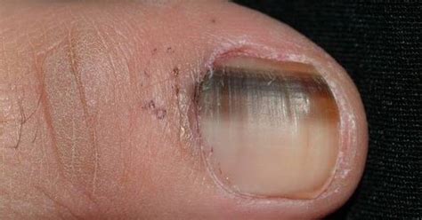 Nail melanoma: know the signs | The Senior | Senior