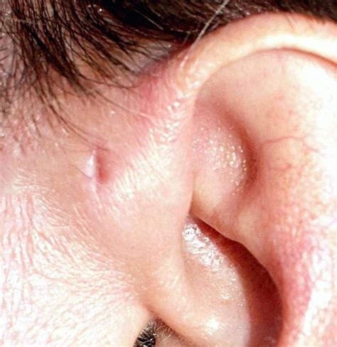 Hole in ear (preauricular pit): What to know