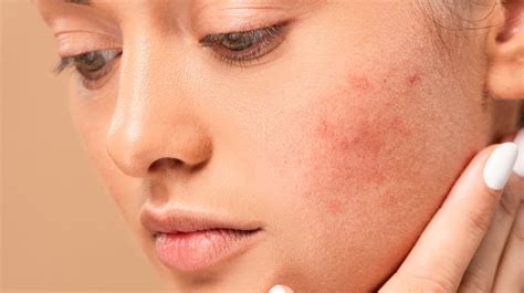 What Causes Hormonal Acne - The Skincare Edit