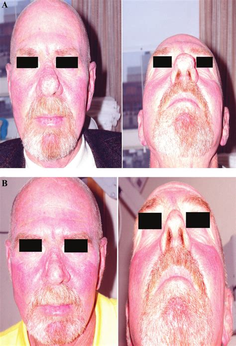 Moderate rhinophyma treatment with CO 2 laser. A, Preoperative frontal ...