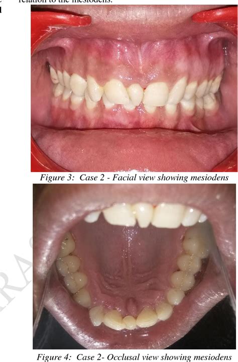 Figure 4 from Mesiodens-A Report Of Two Cases | Semantic Scholar