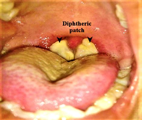 Diphtheria Pseudomembrane Removal