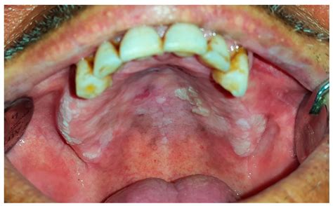 15 Oral Soft Tissue Lesions And Minor Oral Surgery