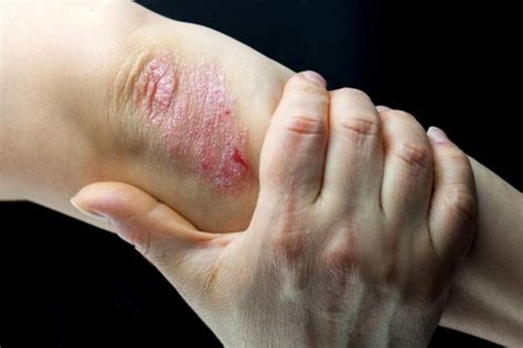 Penyakit Kulit Psoriasis – newstempo