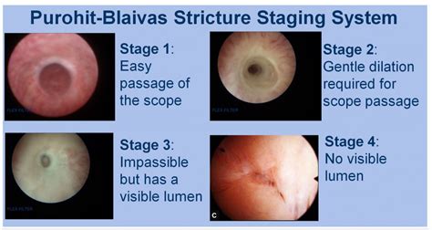 Urethral Stricture