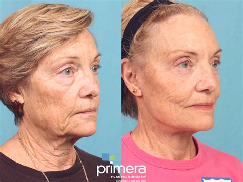 Mini Facelift Before and After Pictures Case 810 | Orlando, Florida | Primera Plastic Surgery