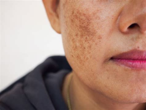 Hyperpigmentation | Treatment, Types and Causes