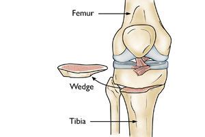 Osteotomy of the Knee - OrthoInfo - AAOS