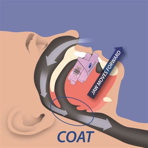 somnomed vs cpap - Google Search | Family dental, Dental, Beauty