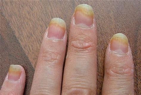 Fingernail Fungus : Causes, Picture, Symptoms And Treatment