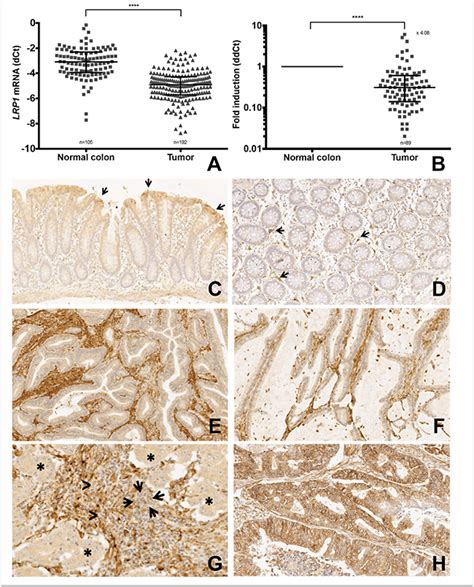 LRP1 expression in colon cancer predicts clinical outcome | Oncotarget