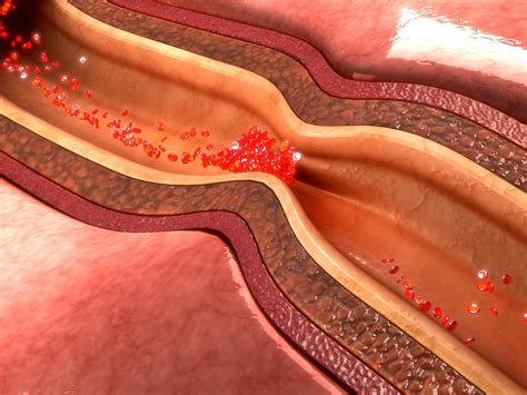 Coronary Artery Disease Symptoms Death - PELAJARAN