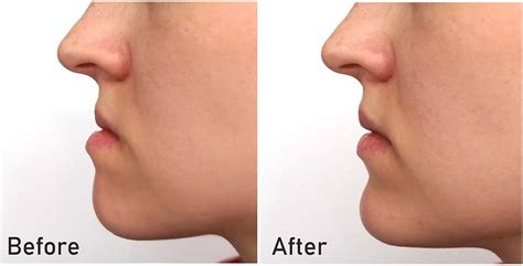 Can Braces Fix Jawline and Improve Your Chin? | Elara Orthodontics