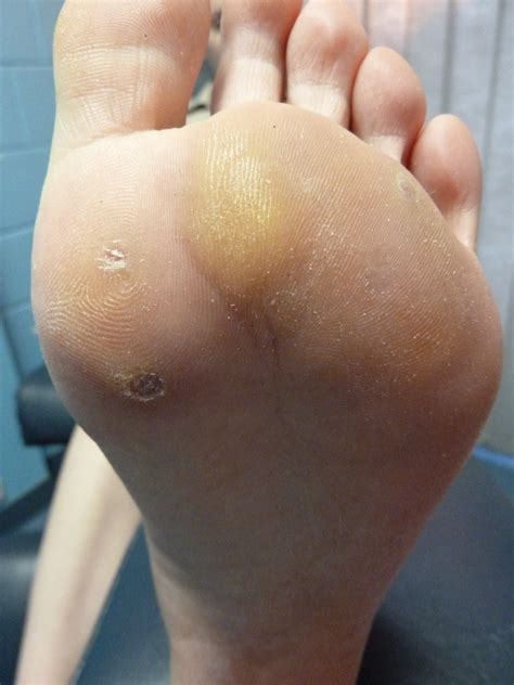 removing plantar warts – Warts