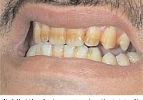 Figure 2 from Doxycycline-induced staining of permanent adult dentition. | Semantic Scholar